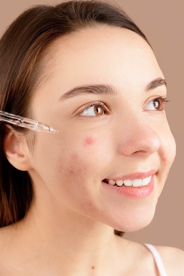 How to Get Rid Of Acne ?
